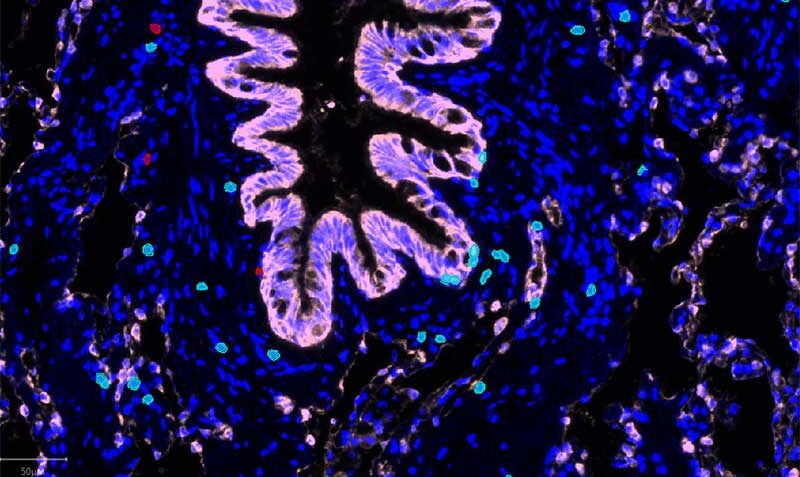 This immunofluorescence image shows the presence of a specific subset of T cells (tissue-resident memory T cells, TRM) in the lung of smoker patients. The TRM cells are represented here in aqua and red, the lung airways are depicted in pink, and the cell nuclei are depicted in dark blue.