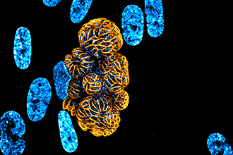  A Toxoplasma-infected human cell moments before it bursts