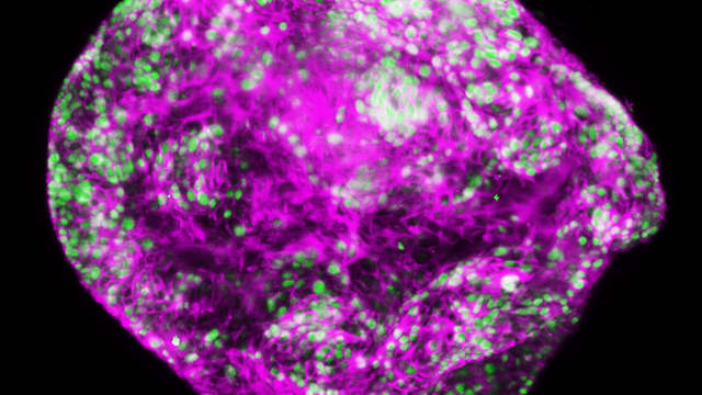 Gastric cancer cells under the microscope.