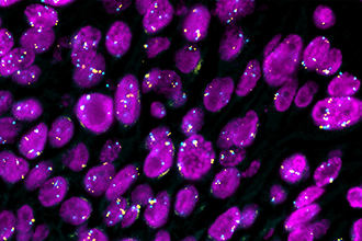 Lung squamous cell carcinoma