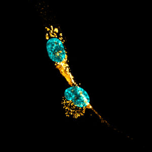 Microscope view of reactive human astrocytes