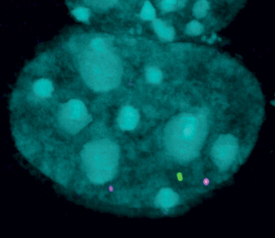 SCHMD1 gathering SMCHD1 is involved in gathering pieces of DNA together. Two of these pieces are marked with magenta and green dots, while all the DNA is marked in turquoise. (Credit: WEHI)
