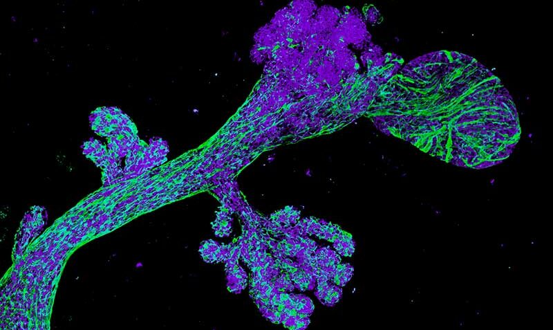 Pre-cancerous breast tissue from a BRCA2 mutation carrier. Credit: Bianca Capaldo, WEHI