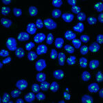 Treating acute lymphoblastic leukaemia cells with the drug CX-5461 disrupts the nucleolar ribosome machinery shown by the fibrillarin protein (green) in the nucleus (blue) that stimulates the nucleolar stress response and initiates leukaemia cell death. Credit: Peter Mac