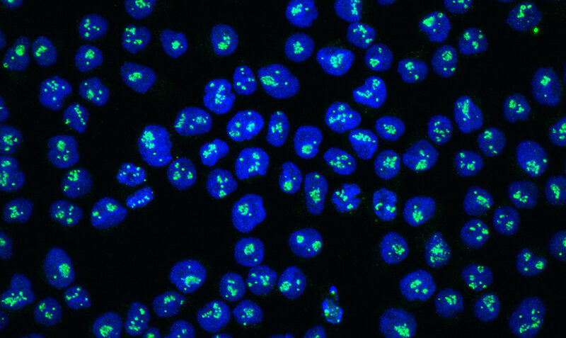 Treating acute lymphoblastic leukaemia cells with the drug CX-5461 disrupts the nucleolar ribosome machinery shown by the fibrillarin protein (green) in the nucleus (blue) that stimulates the nucleolar stress response and initiates leukaemia cell death. Credit: Peter Mac