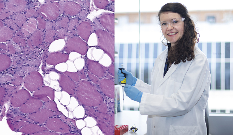 A microscopic image of myositis muscle showing scattered necrotic muscle fibres, stained pink for scientific analysis (left). Dr Jessica Day (right)