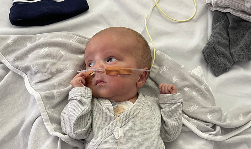 Freddie as a baby wearing a nasal gastric tube