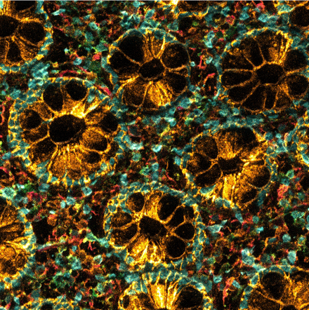 Cancer tissue captured under a microscope and stained in colours