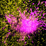 Chimeric Antigen Receptor (CAR) T cells, genetically engineered leukocytes (white blood cells), in their fight against glioblastoma, a deadly type of glioma.