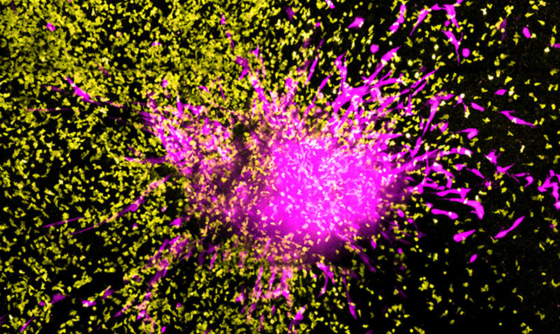 Chimeric Antigen Receptor (CAR) T cells, genetically engineered leukocytes (white blood cells), in their fight against glioblastoma, a deadly type of glioma. Credit: WEHI