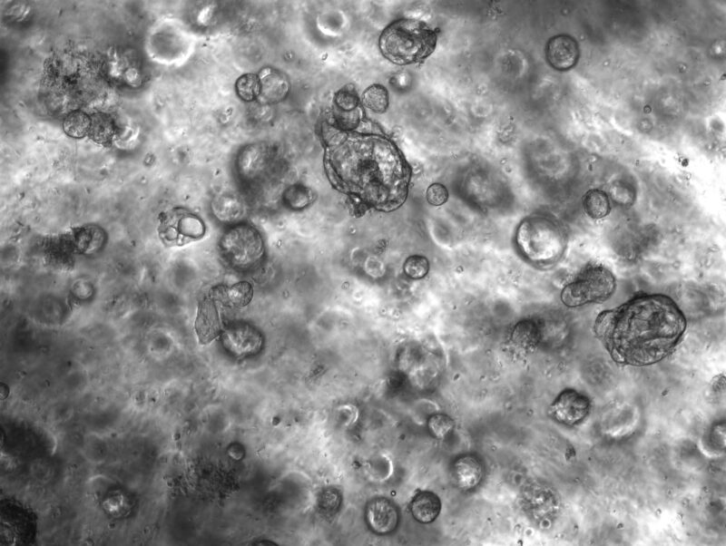 HGSEC organoids grown in extracellular matrix