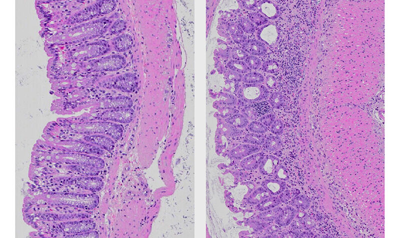 Microscopic images of sections of the colon from mice. Mice fed a normal diet (left) have healthy, well-organised gut tissues. In contrast, mice fed a diet high in fat (right) have disrupted gut tissue, a thickening of the gut wall (pink) and an accumulation of immune cells (purple dots) – clear signs of inflammatory bowel disease.