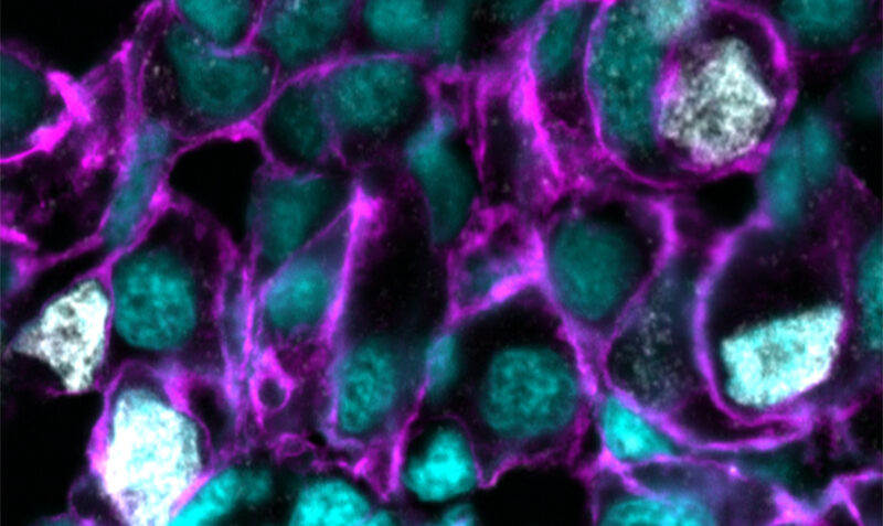 A section of liver tumour in a zebrafish shows liver cell DNA (cyan), cancer cells with KRAS activity (purple), and DNA damage (white). The study found that lowering a key protein involved in minor splicing causes DNA damage selectively in cancer cells, leading to the expression of the p53 tumour suppressor protein.