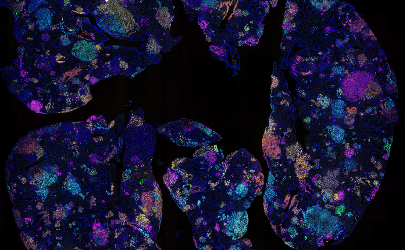 Blood signature found to predict lung cancer risk years before diagnosis