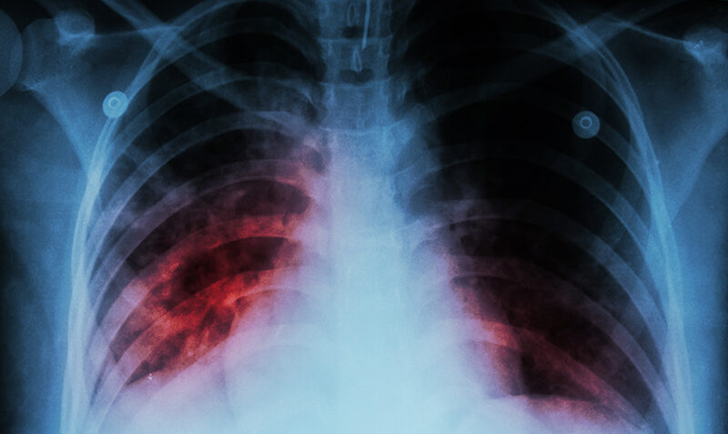 Chest x-ray showing lung inflammation caused by M. tuberculosis infection.