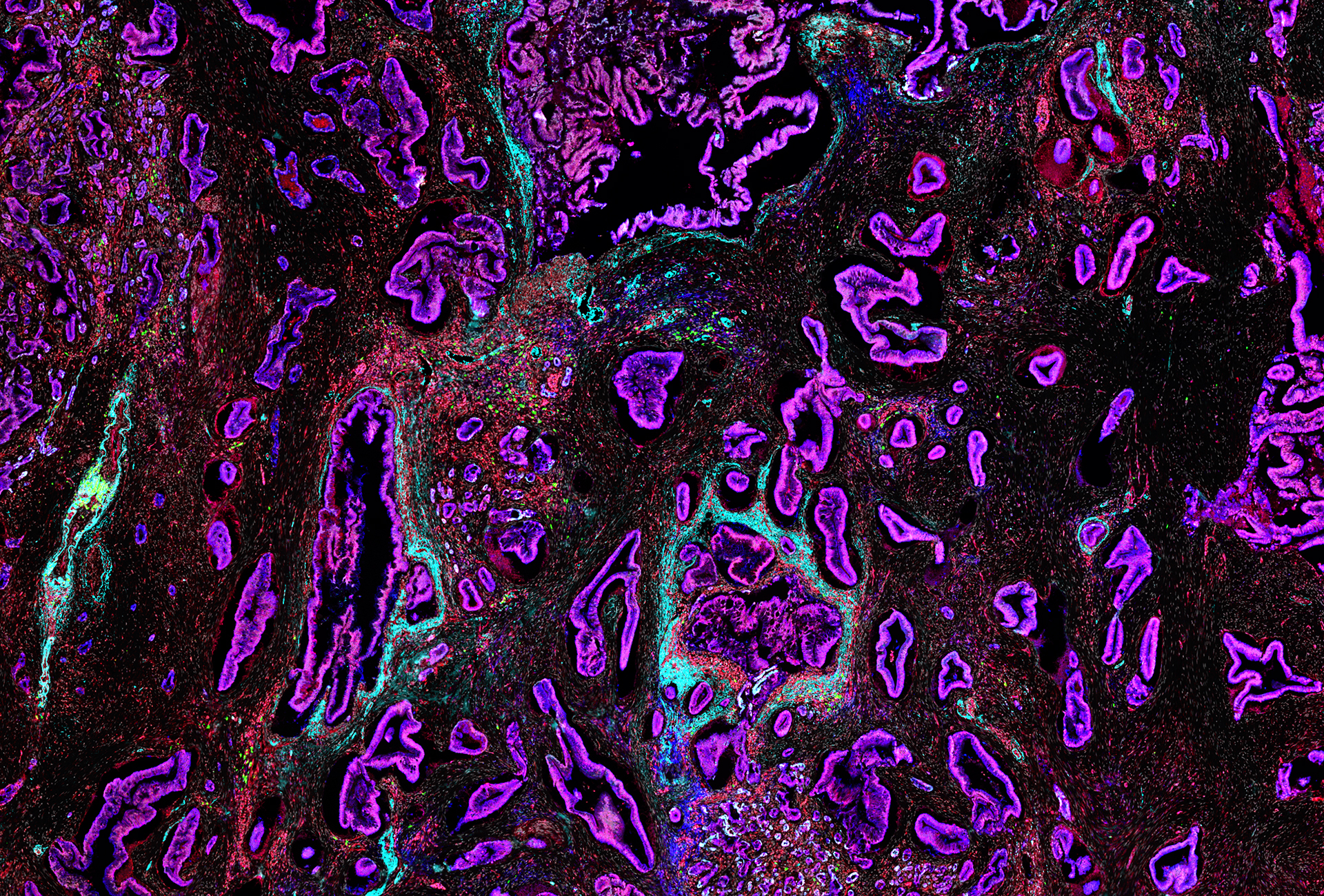 Pancreatic cancer cells (purple) build a dense, protective fortress of tissue to hide from treatment and the immune system. Learning to dismantle these walls can help therapies reach the tumour and improve patient survival rates.