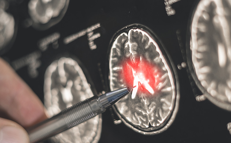 A photo shows a brain scan with a section illuminated in red